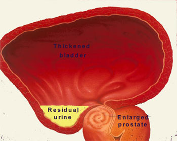 Fig 3. BPH causes bladder blockage leading to residual urine
