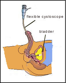 Fig 2. Flexible cystoscopy can easily be done in the clinic under local anaesthesia