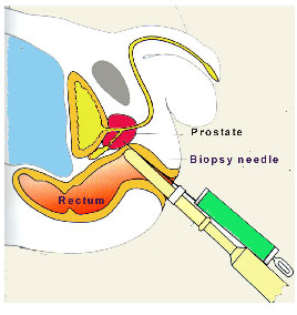 Fig 1. Prostate biopsy is done under ultrasound guidance