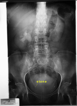 Picture of contrast injection (IVU)
