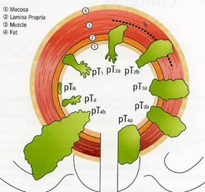 Are all bladder tumor diagnoses cancerous?