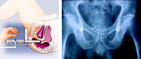 Picture of Brachytherapy