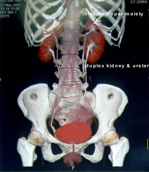 Left Kidney