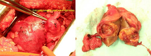 nephrectomy Picture of nephrectomy