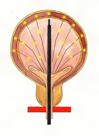Picture of Botox injections