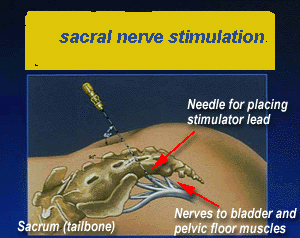 Picture of Sacral Nerve Stimulation