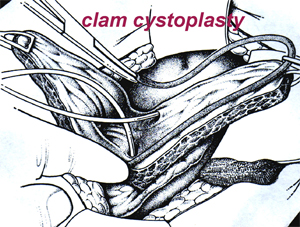 Picture of Augmentation cystoplasty