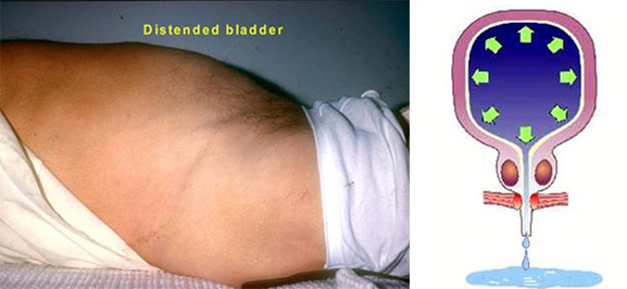 Picture of Overflow incontinence