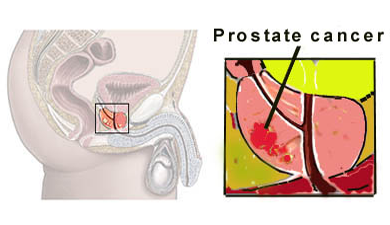 Prostate Cancer
