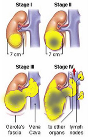 Stages of kidney cancer Picture of Stages of kidney cancer