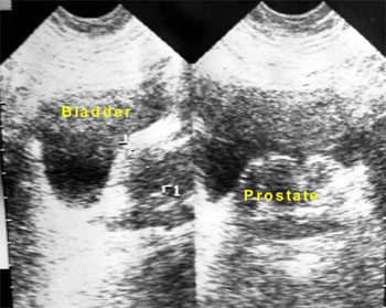 Benign Prostatic Hyperplasia BPH in Singapore - Chin Chong Min Urology