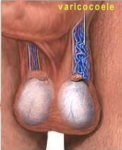 Picture of Varicocoele