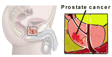 Prostate Radical prostatectomy