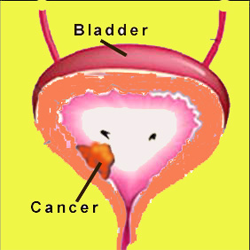 Radical cystectomy