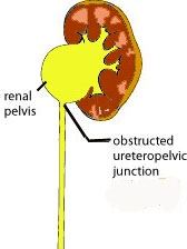 Pyeloplasty