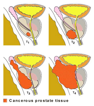 Bladder Cancer in Dogs - Causes, Symptoms, and Treatment Options Available