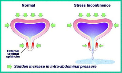 Stress Incontinence