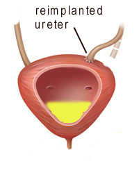 ureter reimplantation surgery