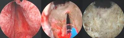 Greenlight Laser TURP Picture of Greenlight Laser TURP