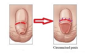 Picture of Circumcision