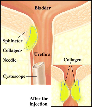Picture of Collagen Injection