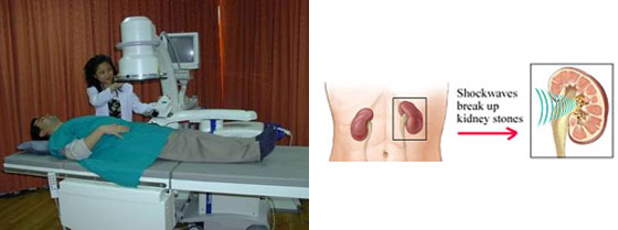 Picture of Extracorporeal shock wave lithotripsy (ESWL)