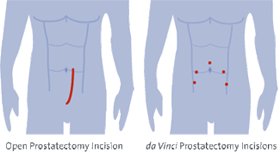 Radical Prostatectomy