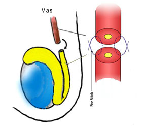 Reversal of Vasectomy