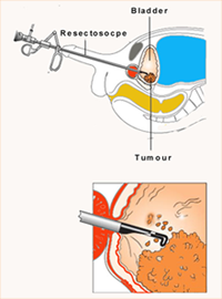 Transurethral Resection of Bladder Tumour (TURBT)