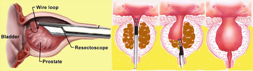 Transurethral Resection of Prostate (TURP)