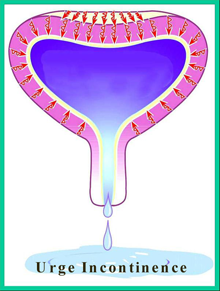 Picture of Botox Bladder Injections