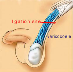 Varicocoelectomy