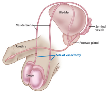 Vasectomy