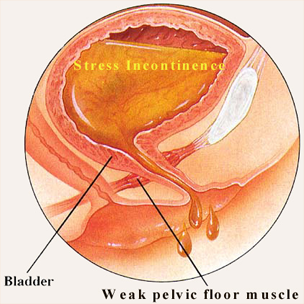 Picture of Collagen Injection